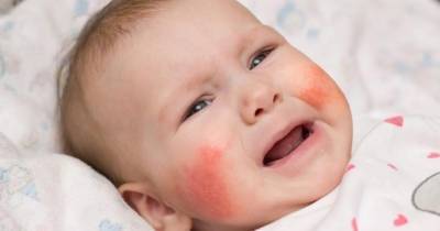 Rebenok-cvetet - запись пользователя (:юляkiona:) (kiona) в сообществе здоровье новорожденных в категории аллергия - babyblog.ru