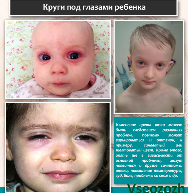 Темные круги под глазами у ребенка – причины и лечение?
