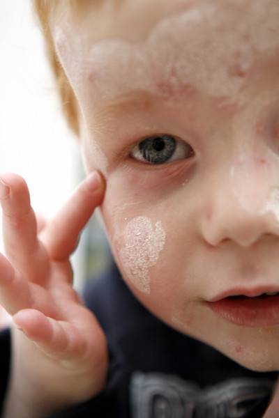 Причины шелушения кожи у новорожденного и способы решения проблемы