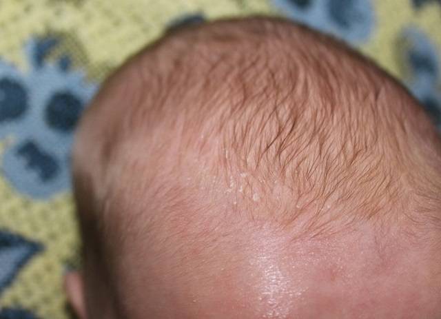 Молочные корочки на голове младенца