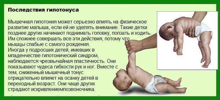 Гипотонус мышц у младенцев — симптомы слабого тонуса