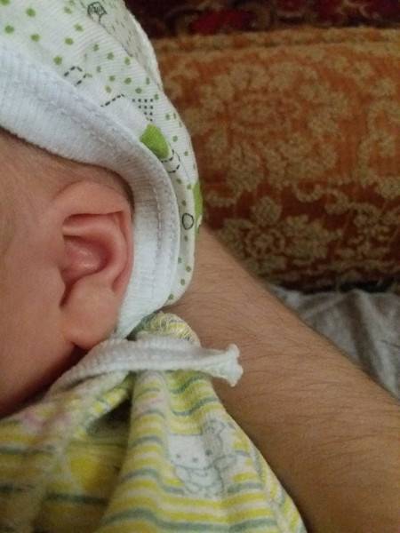 Почему у новорожденного разные уши — возможные причины