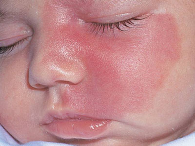 Пламенеющий невус у новорожденных: причины, диагностика и лечение винных пятен