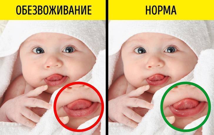 Лечение ротавирусной инфекции у младенцев