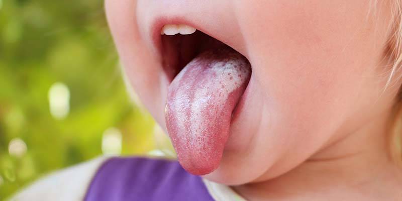 Как лечить миндалины в горле у ребенка