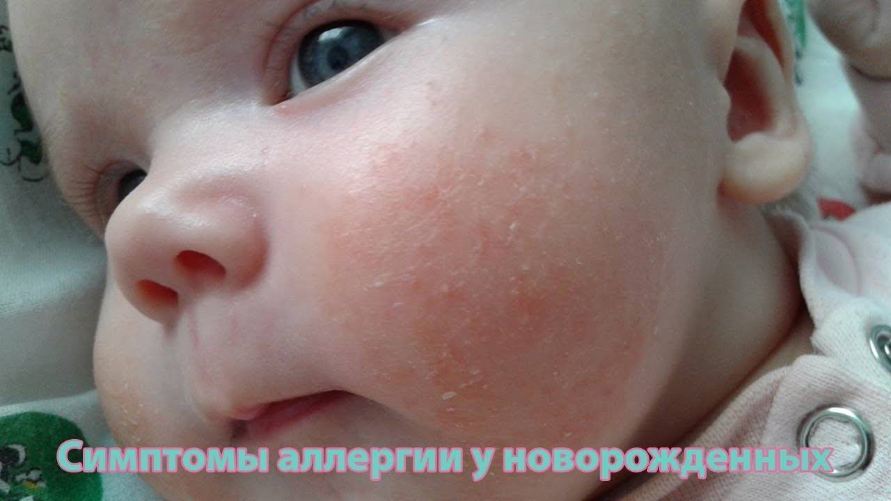Аллергия на памперсы? - запись пользователя дарья (dvasina) в сообществе детские болезни от года до трех в категории аллергия - babyblog.ru