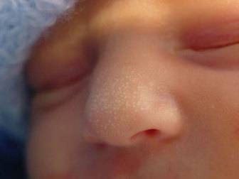 Прыщики на лице у новорожденного в 1-2 месяц с белой головкой
