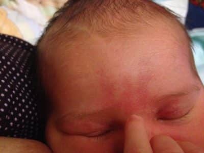 Родимые пятна у новорожденных — какие бывают и как избавится