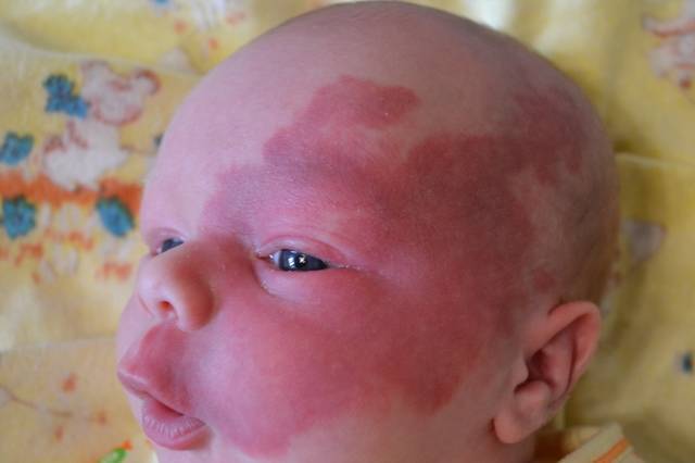 Пятнышко на лбу у новорожденного когда исчезнет. красные пятна на затылке, лице и теле у новорожденного: виды родовых отметин с фото