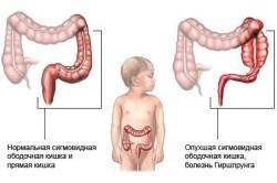 Как проявляется долихосигма кишечника у ребенка?