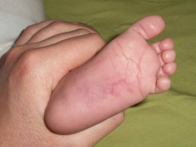 Сыпь на теле у ребенка (64 фото): причины высыпаний по всему телу с пояснениями, бесцветная сыпь после температуры