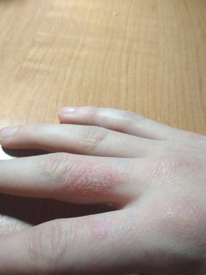 Шелушение кожи на пальцах рук: причины и способы лечения