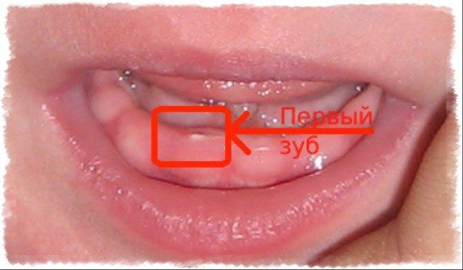 Признаки прорезывания зубов у грудничка
