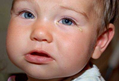 Слезится глаз у ребенка — возможные причины выделения слезной жидкости