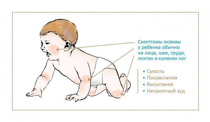 Антигистаминные препараты для детей, новорожденных. список нового поколения