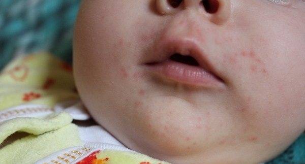 Сыпь около рта у ребенка фото с пояснениями