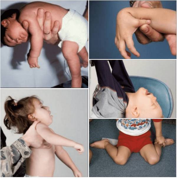 Тонус мышц у ребенка: почему возникает и как лечить?