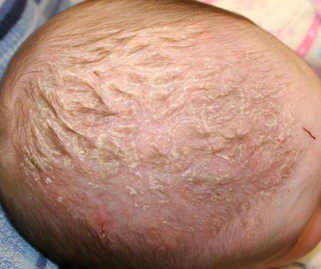 Почему шелушится кожа у ребёнка: причины, диагностика, лечение