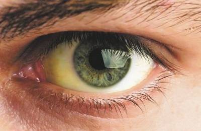 Желтые белки глаз у новорожденных: причины и симптомы, фото, лечение