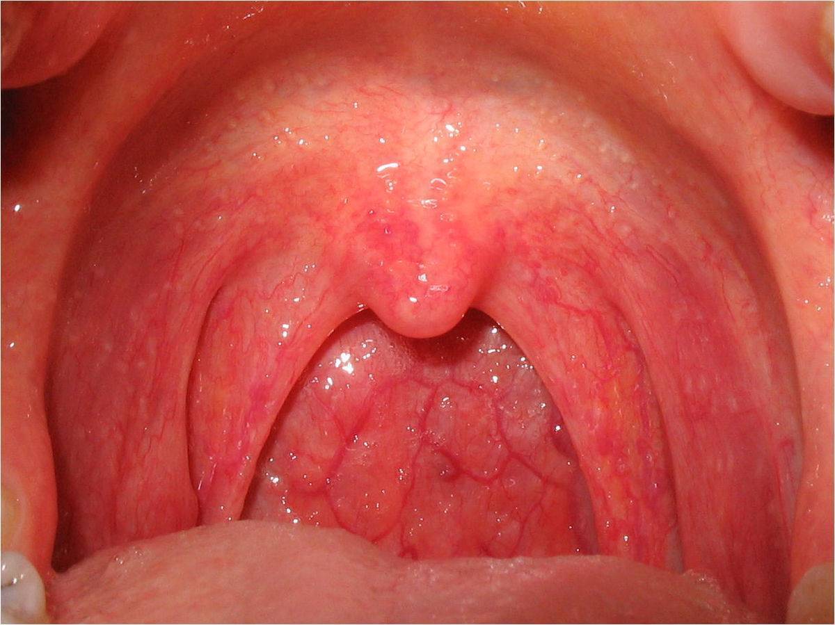 Как выглядит здоровое горло у ребенка и больное (27 фото): нормальное и воспаленное, при аденоидах, рыхлое горло и с красными точками