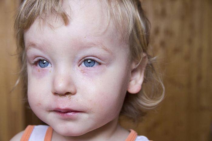 У ребенка гноится глазик: что делать и чем лечить?