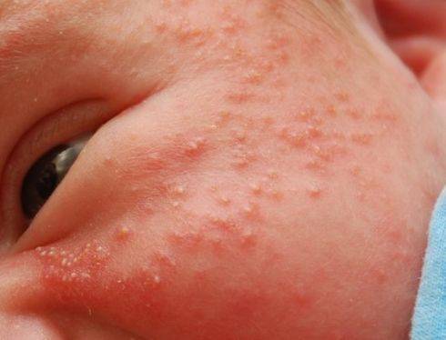 Аллергия,потница или акне новорожденных?