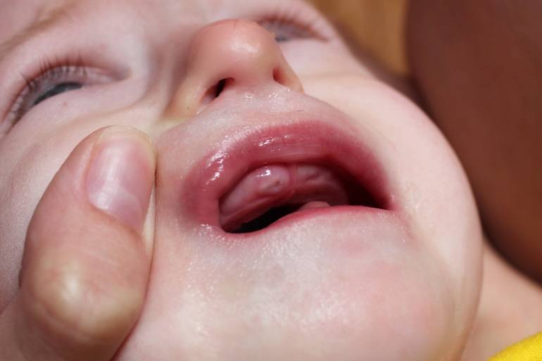 Во сколько месяцев начинаются резаться первые зубки у младенцев