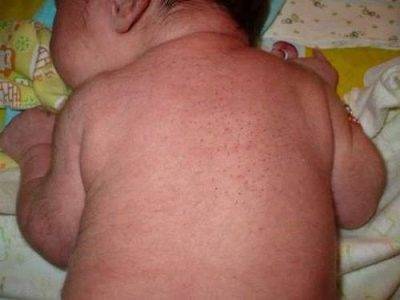 Вытерся затылочек - у грудничка вытерся затылок - запись пользователя галина (mamagashi) в сообществе здоровье новорожденных в категории разное - babyblog.ru
