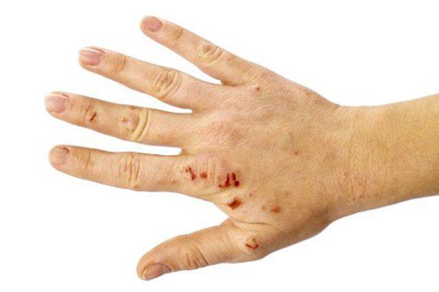 Сыпь на запястьях рук: фото, возможные заболевания, лечение