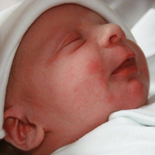 Бесцветная сыпь на лице у ребенка - вопрос дерматологу - 03 онлайн