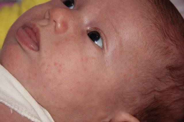Шершавая кожа у ребенка: причины и рекомендации