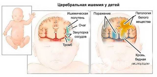 Ишемия головного мозга у новорожденного: что это, последствия и лечение, степени и особенности поражения у недоношенных детей