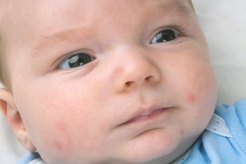 Сыпь у новорожденного, грудничка и месячного ребенка: причины красных высыпаний с пояснениями, красная и мелкая сыпь теле, голове и щеках