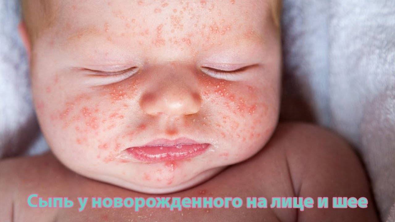 Аллергия на лице у грудничка