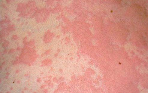 Как выглядит аллергия на подгузники и как ее лечить?
