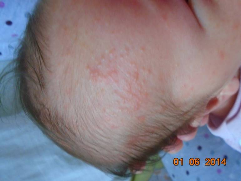 Сыпь у новорожденного на лице и голове