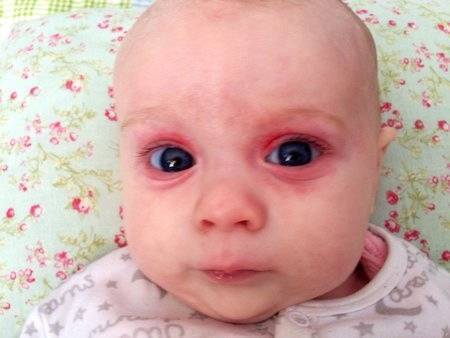 У ребенка круги под глазами красные и розовые пятна – причины
