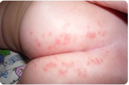 Аллергия на попе у ребенка