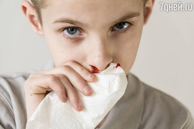У ребенка часто идет кровь из носа, что делать. причины, последствия, лечение