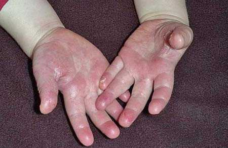 Облазит кожа на пальцах рук у ребенка  отслаивается кожа на пальчиках, причины