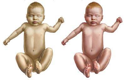 Желтуха новорожденных (для врачей и пациентов) (рмс) - начальная стадия желтухи у новорожденных - запись пользователя komareks (id1821139) в сообществе здоровье новорожденных в категории желтуха новорожденных - babyblog.ru
