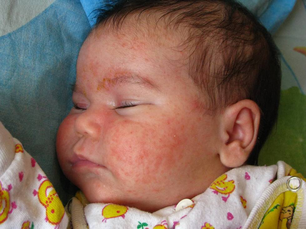 О красных пятнах на лице у новорожденного: высыпания на коже головы