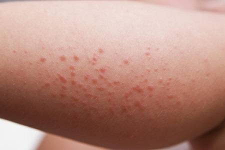 Аллергия на локтях
