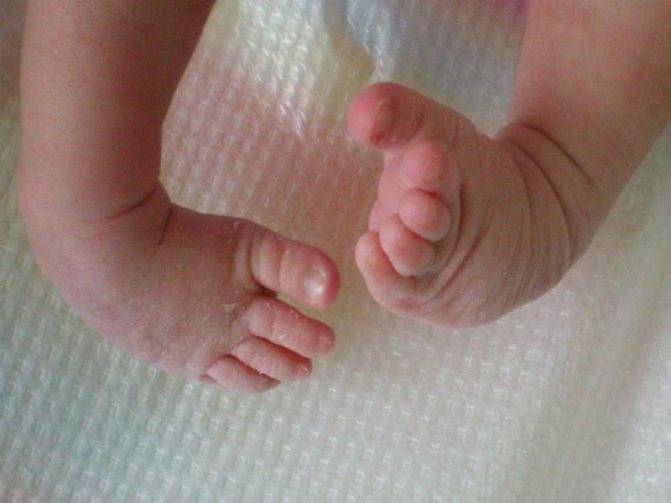 Что делать, если у новорожденного шелушится кожа на теле, руках и ногах