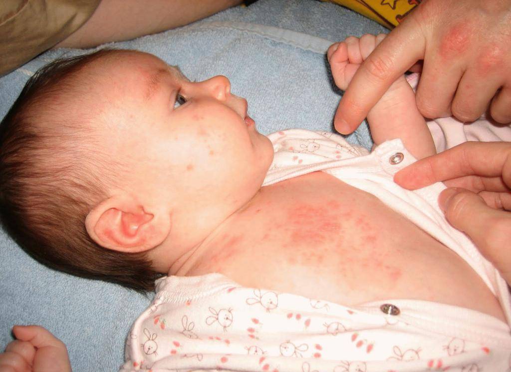 Koshachya-sherst-allergiya - запись пользователя екатерина (katty-kat) в сообществе здоровье новорожденных в категории аллергия - babyblog.ru
